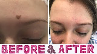 Mole removal  Before and After [upl. by Arielle]