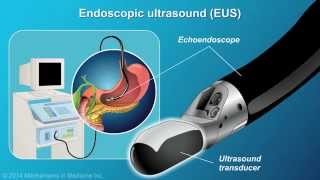 Understanding EUSFNA [upl. by Denice]