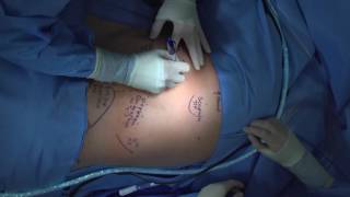 Technique for Chest Tube Insertion [upl. by Naashom851]