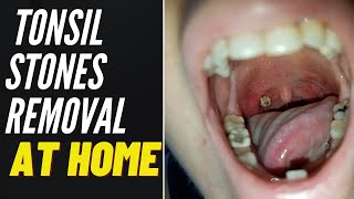 TONSIL STONE REMOVAL At Home 2021 [upl. by Werdn316]