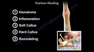 Fracture Healing  Everything You Need To Know  Dr Nabil Ebraheim [upl. by Alwyn]