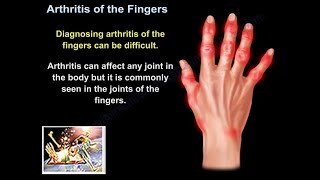 Arthritis Of The Fingers  Everything You Need To Know  Dr Nabil Ebraheim [upl. by Queena]