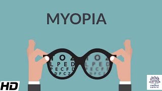 Myopia Signs and Symptoms Causes Diagnosis and Treatment [upl. by Biernat]