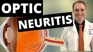 Optic Neuritis Symptoms Diagnosis and Treatment [upl. by Cammie]