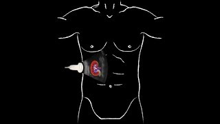 POCUS  Basic Renal Ultrasound [upl. by Rednasyl184]