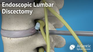 Endoscopic Lumbar Discectomy [upl. by Maller]