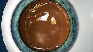 Vision Correction for High Levels of Myopia amp Astigmatism [upl. by Eneluj]