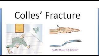 Orthopedics 130 Colles fracture Dorsal tilt Complications Dinner fork deformity Darrack Sudeck [upl. by Naehgem]