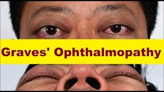 Graves Ophthalmopathy [upl. by Accire]