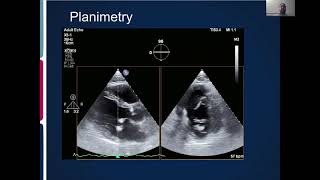 Joint Echo Conference Mitral Stenosis [upl. by Nike97]