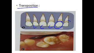 classification of malocclusion [upl. by Gabriell]