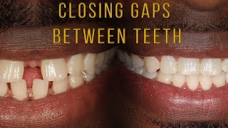 Closing Gaps Between Teeth With Braces [upl. by Erialb]