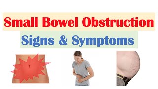 Small Bowel Obstruction SBO  Risk Factors Causes Signs amp Symptoms Diagnosis Treatment [upl. by Annawt]