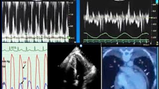 Constrictive pericarditis diagnosis echocardiography and treatment [upl. by Iadrahc668]