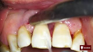 Advanced periodontal disease [upl. by Werdnael590]