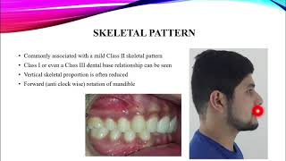 Class II Div 2 malocclusion [upl. by Vesta734]