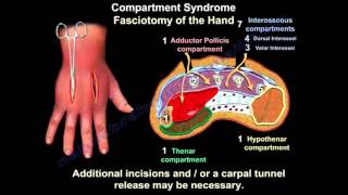 Síndrome Compartimental da Mão [upl. by Tannenwald]
