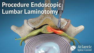 Procedure Endoscopic Lumbar Laminotomy [upl. by Ainsley]