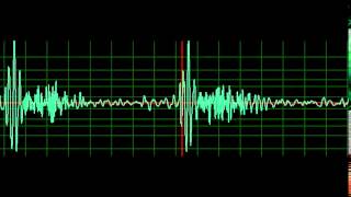 Mitral Regurgitation normal speed [upl. by Pierrepont450]