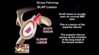 SLAP Lesion  Everything You Need To Know  Dr Nabil Ebraheim [upl. by Yetty]