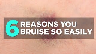 6 Reasons You Bruise So Easily  Health [upl. by Ahidam]