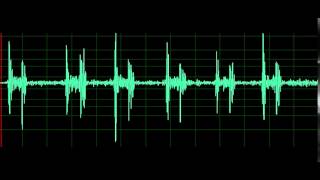 Pulmonary Associated Heart Sounds Tricuspid Regurgitation [upl. by Bannasch802]