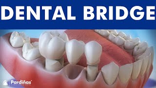 Dental bridge  Fixed dental replacement © [upl. by Rufford]