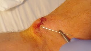 How To Give Yourself Stitches Sutures [upl. by Alecia]