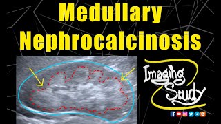 Medullary Nephrocalcinosis  Ultrasound  Case 128 [upl. by Elison]