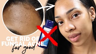 HOW TO TREAT FUNGAL ACNE Malassezia FAST  THE BEST WAY [upl. by Tilford]