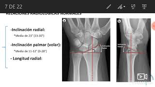 FRACTURAS DE RADIO DISTAL REVISIÓN DEL TEMA [upl. by Ahders84]