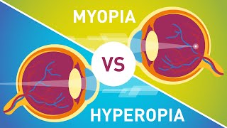 Difference between Myopia Near Sightedness amp Hyperopia FarSightedness [upl. by Kenleigh349]