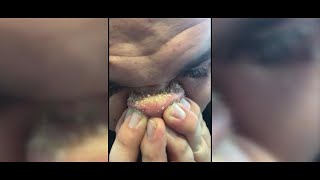 DIY Blackhead Removal Goes Viral [upl. by Letsyrk]