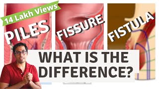 Piles  Fisure  Fistula  Difference explained  Dr Vishal Tomar  Open Consult [upl. by Assyl]