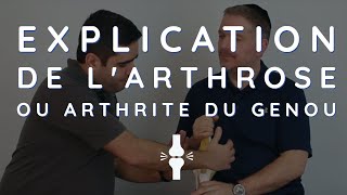 Explication de lArthrose ou Arthrite du Genou [upl. by Ataynek]