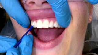 Tips For Applying Fluoride Varnish [upl. by Raymund425]