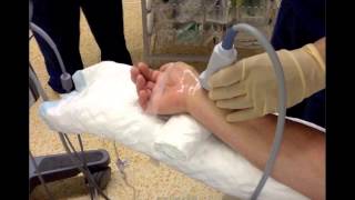 US GUIDED RADIAL ARTERY CANNULATION [upl. by Koffman]