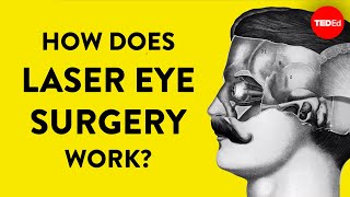 How does laser eye surgery work  Dan Reinstein [upl. by Morice]