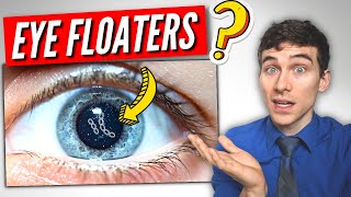 3 Must Know Facts About EYE Floaters [upl. by Merriman308]