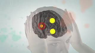 Animated video illustrating the pathophysiology of migraine [upl. by Noryd]