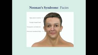 Noonans Syndrome  CRASH Medical Review Series [upl. by Llohcin]