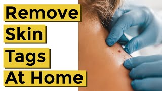 How to Quickly and Easily Remove Skin Tags at Home Using Things You Already Own [upl. by Anahsohs]