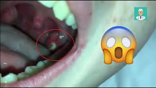 Tonsil Stone Removal by ENT Doctor  Medic4arab 😨🔥 [upl. by Con]