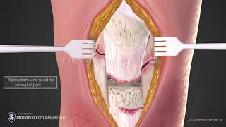 Patella Fracture Repair [upl. by Mich]