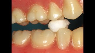 The Chew Test  Diagnosing amp Adjusting Denture Occlusion [upl. by Patrizius]