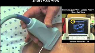 How To Ultrasound Guidance for Central Venous Access Part 1 Case Study [upl. by Nosiaj]