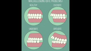 Different Types of Malocclusions [upl. by Orgel333]