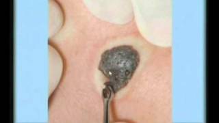 Seborrheic Keratosis Treatment [upl. by Ettenim]