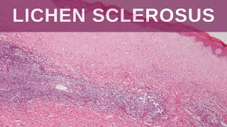 Lichen Sclerosus  Pathology mini tutorial [upl. by Bohrer]