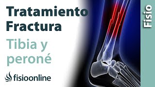 FRACTURA de TIBIA y PERONÉ Tratamiento desde la fase de INMOVILIZACIÓN [upl. by Ttenna]